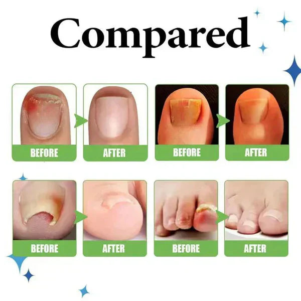 Anti Paronychia Relief Oil - (Buy 1 Get 1 FREE)