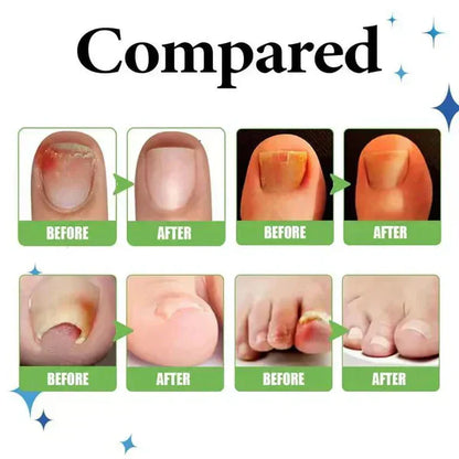 Anti Paronychia Relief Oil - (Buy 1 Get 1 FREE)